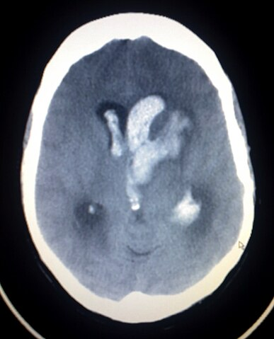 StrokeResearch2's tweet photo. A transient ischemic attack (TIA), commonly known as a mini-stroke, is a minor stroke whose noticeable symptoms usually end in less than an hour
https://t.co/yBwh9ptUCK https://t.co/AkbkvnhRSS