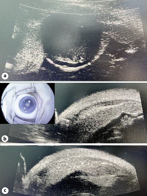 OphthaKarger's tweet photo. Massive Uveal Relapse of Retinoblastoma Presumed to Be Choroidal Tumorous Involvement: Case Series
โก๏ธ https://t.co/gaR5RhW6uo
โ๏ธ Ghassemi F. et al.
๐ #CaseRepOphthalmol
#OpenAccess https://t.co/YBdPWhVcKZ