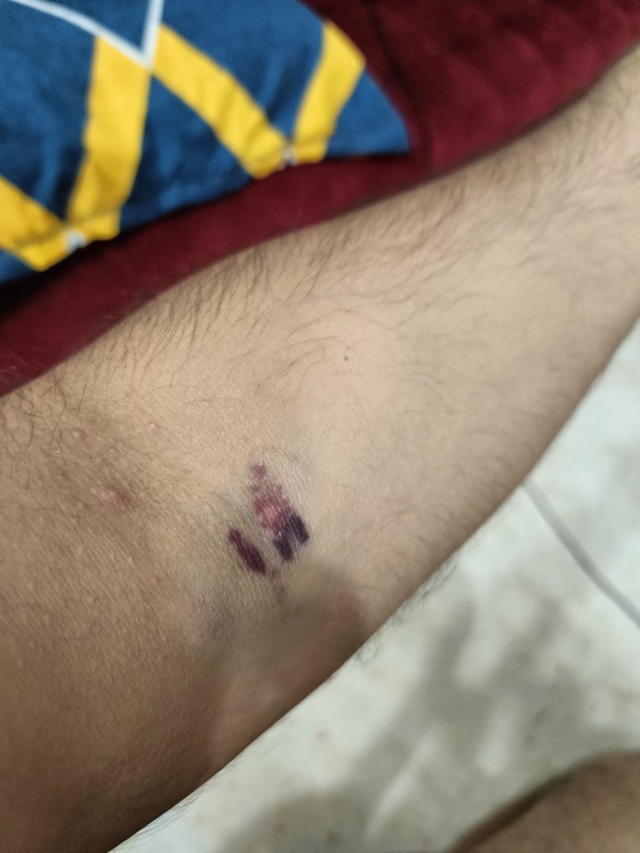 pushpinder333's tweet photo. I went for my #CBC test to @lalpathlabs Ramesh Nagar, Delhi. Turned out to be the Biggest Mistake of my life!
This is what their #untrained staff has done to me. 
I will never ever go and recommend #lalpathlabs to anyone. 
@IMAIndiaOrg https://t.co/l1RQHJcHjA
