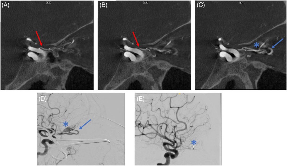 Surgical Exposure and Direct Puncture of a Thrombosed Superior Ophthalmic Vein in an Optic Nerve Sheath Dural Arteriovenous Fistula | Stroke: Vascular and Interventional Neurology ahajournals.org/doi/full/10.11… @StrokeAHA_ASA @SVINJournal @svinsociety