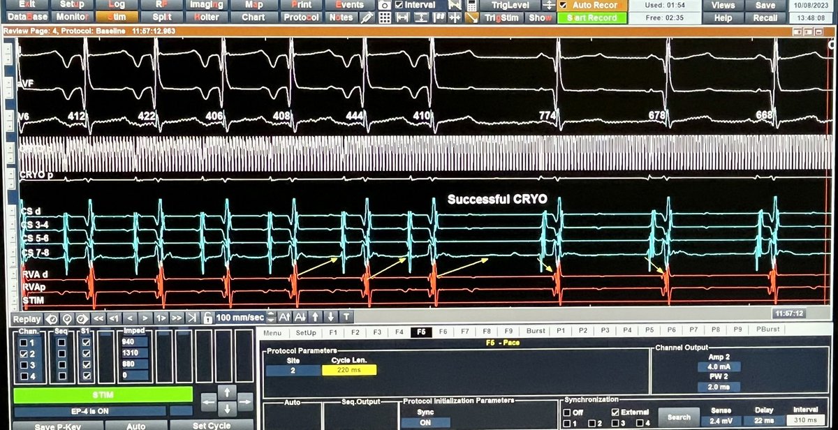 #Epeeps 2 years old 12 kg patient with multiple antiarrhythmic resistant (beta blocker+flecainide+amiodarone) long RO SVT: Successful transjugular PJRT Cryoablation(from CS ostium - 6 mm tip-Cryo) <a href="/enes_elvin/">Enes Elvin Gul, MD, FESC, FEHRA</a> <a href="/serdar_ustakurt/">serdarustakurt</a> <a href="/DursunAras2/">Dursun Aras, Professor</a> <a href="/taylanakgun/">Taylan Akgün</a> <a href="/ozgursurgitMD/">Dr. Ozgur Surgit M.D. Prof. Dr.</a>