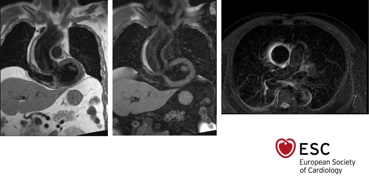 #ImageOfTheWeek was submitted by <a href="/PohlsRicardo/">Ricardo Pöhls Vázquez</a>, <a href="/LawrenzJorge/">Jorge Cortes Lawrenz</a> and Rosa Elba Antillón Pérez from the Hospital CIMA de Hermosillo, Mexico. 

What is the diagnosis? bit.ly/3rYliop

#cardioed #ESCYoung #cardiology #CVD