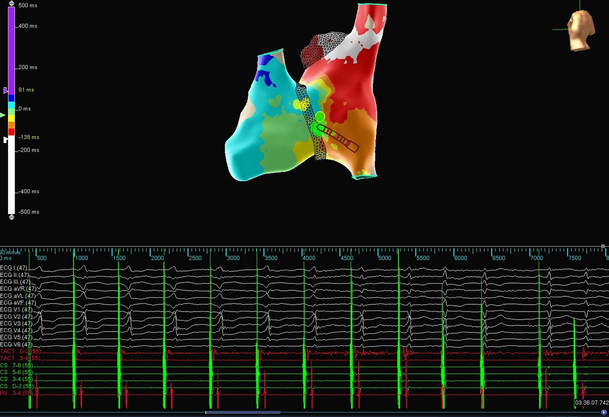 Msalmanghazni's tweet photo. 40 female with H/o Palpitation for last 3 years. Echo normal.
ECG attached previously. 3D mapping with Ensite system done, showed excellent AP potentials, with 2 3 secs of RF AP gone. @Mohamed74057845 @AbbottCardio #EPeeps #Md #MdTwitter #ECG https://t.co/nTpOtfCgiE