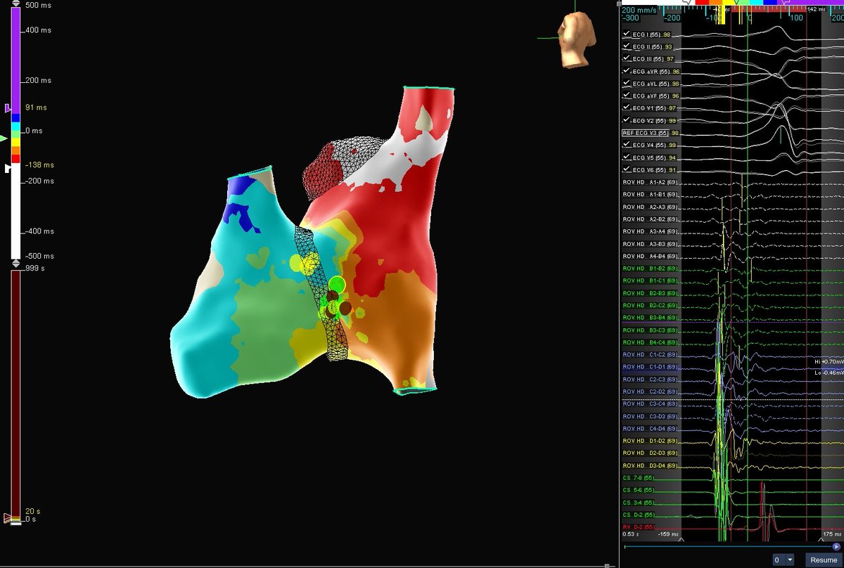 Msalmanghazni's tweet photo. 40 female with H/o Palpitation for last 3 years. Echo normal.
ECG attached previously. 3D mapping with Ensite system done, showed excellent AP potentials, with 2 3 secs of RF AP gone. @Mohamed74057845 @AbbottCardio #EPeeps #Md #MdTwitter #ECG https://t.co/nTpOtfCgiE