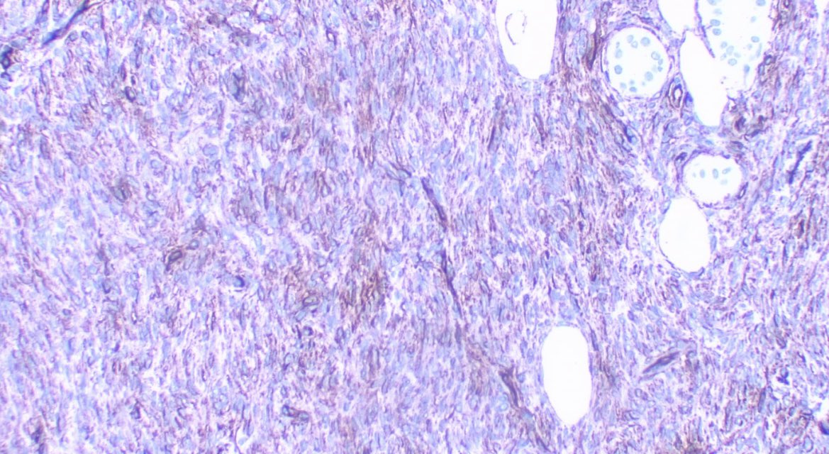 JCandidoXavier's tweet photo. DFSP 👀👀👀
🙋♀️42 y/o hand lesion.
Dermal tumor composed of Medium-sized spindle cells infiltrating the adipose tissue in a honeycomb pattern.
Minimal atypia.
CD34+
#pathology #softtissue #dermatopathology #PathTwitter #MedTwitter
@GeronimoJrLapac @pembeoltulu https://t.co/34PSlg1q7z