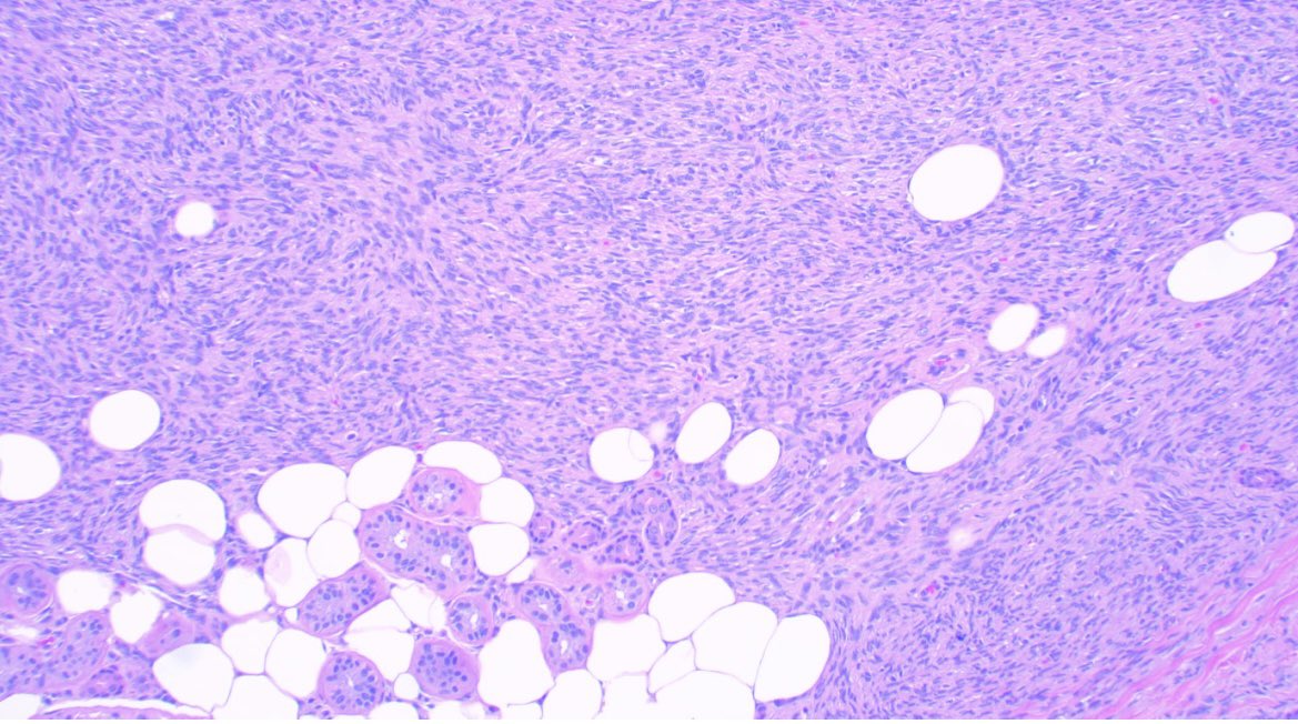 JCandidoXavier's tweet photo. DFSP 👀👀👀
🙋♀️42 y/o hand lesion.
Dermal tumor composed of Medium-sized spindle cells infiltrating the adipose tissue in a honeycomb pattern.
Minimal atypia.
CD34+
#pathology #softtissue #dermatopathology #PathTwitter #MedTwitter
@GeronimoJrLapac @pembeoltulu https://t.co/34PSlg1q7z