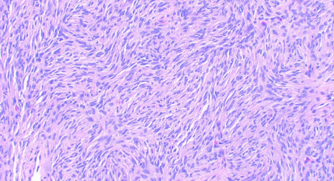 JCandidoXavier's tweet photo. DFSP 👀👀👀
🙋♀️42 y/o hand lesion.
Dermal tumor composed of Medium-sized spindle cells infiltrating the adipose tissue in a honeycomb pattern.
Minimal atypia.
CD34+
#pathology #softtissue #dermatopathology #PathTwitter #MedTwitter
@GeronimoJrLapac @pembeoltulu https://t.co/34PSlg1q7z