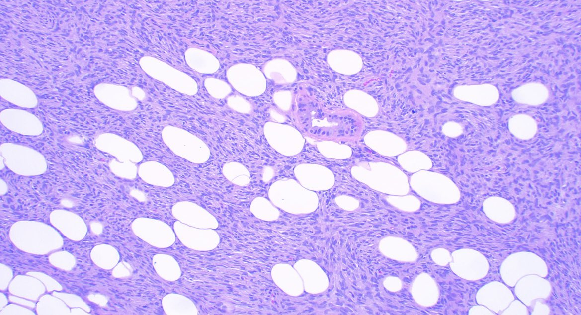 JCandidoXavier's tweet photo. DFSP 👀👀👀
🙋♀️42 y/o hand lesion.
Dermal tumor composed of Medium-sized spindle cells infiltrating the adipose tissue in a honeycomb pattern.
Minimal atypia.
CD34+
#pathology #softtissue #dermatopathology #PathTwitter #MedTwitter
@GeronimoJrLapac @pembeoltulu https://t.co/34PSlg1q7z