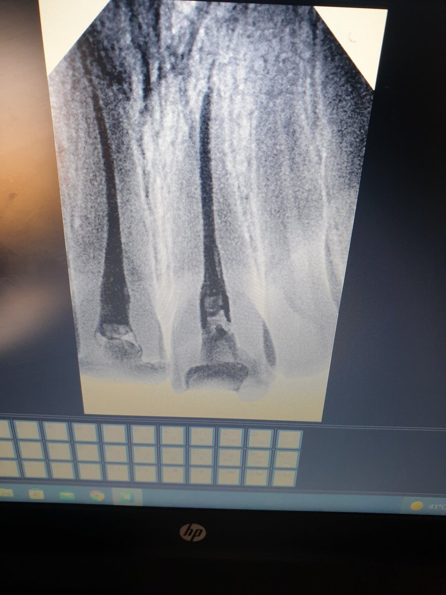 Endodontic Treatment for upper central And upper second Premolar 😊😎🤗
Hope You Enjoy It ❤️
All Comments Are Welcome 😇😇