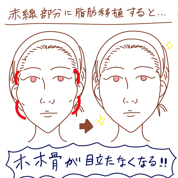 頬骨を骨切りせずに目立たせなくする方法⬇️
写真よりイラストで描いた方が分かりやすい気がする😊骨切りは弛むのが何より怖いから踏み出せない方へ!

#整形垢 #エッセイ漫画 #漫画が読めるハッシュタグ 
