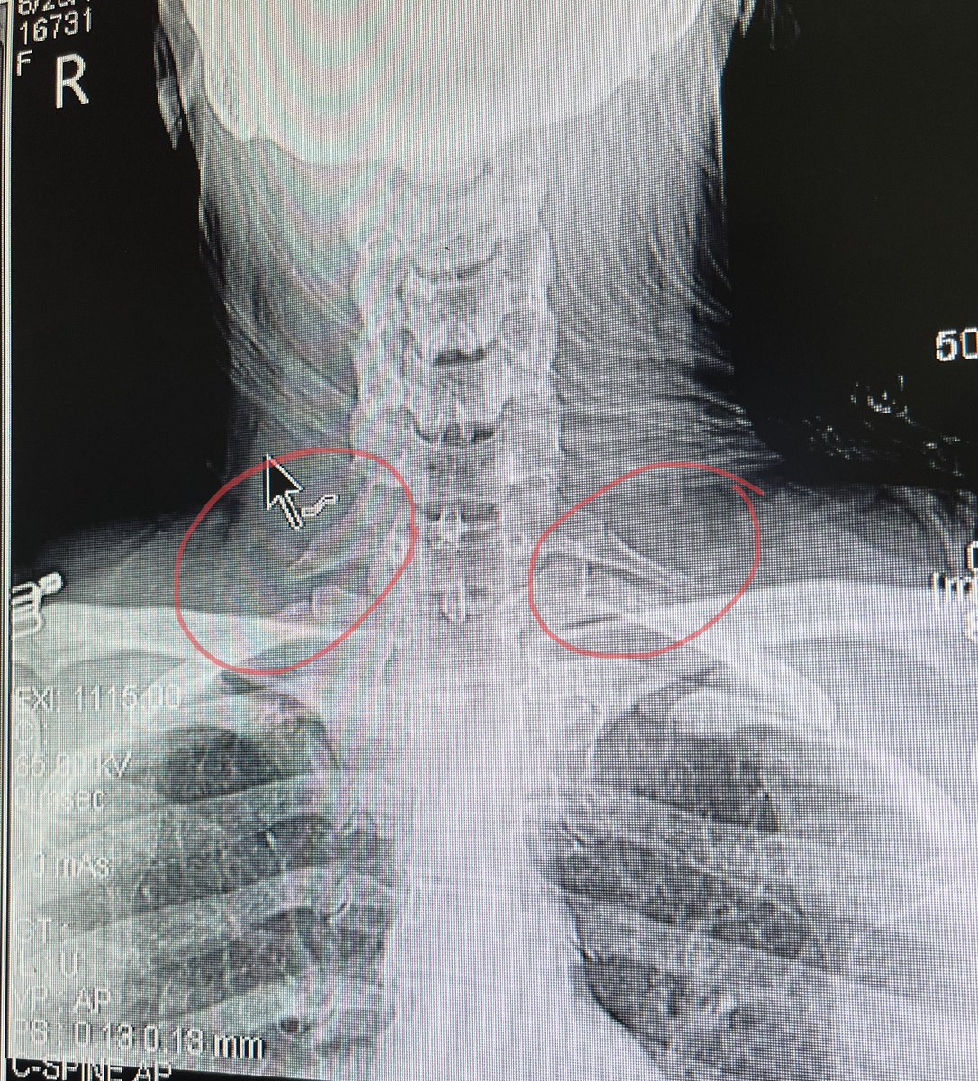 Don’t see this often!!🥸 One of reasons for shoulder pain/arm pain 🤷‍♂️ #cervicalrib #tos #MedEd #MedX #MedTwitter