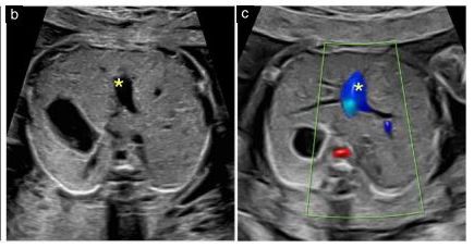 SonographyCNDA's tweet photo. 𝙄𝙣𝙩𝙚𝙧𝙚𝙨𝙩𝙞𝙣𝙜 𝘼𝙧𝙩𝙞𝙘𝙡𝙚: Effective fetal cardiac screening should maximize detection of structural anomalies and abnormalities of function and rhythm, as part of routine prenatal care. Read the full article here:https://t.co/9zcIddnfFr #interestingarticle #updates https://t.co/5XMMwJ5ZSK