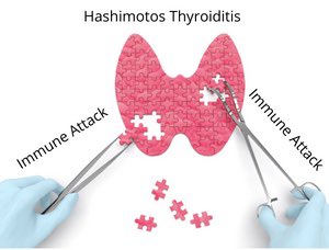 DocNicole's tweet photo. Did you know Hashimoto’s is quite different than standard Hypothyroidism? If you have a thyroid condition, you need to know this!
https://t.co/VHK6IRxYC6 https://t.co/KE7C9l09VB