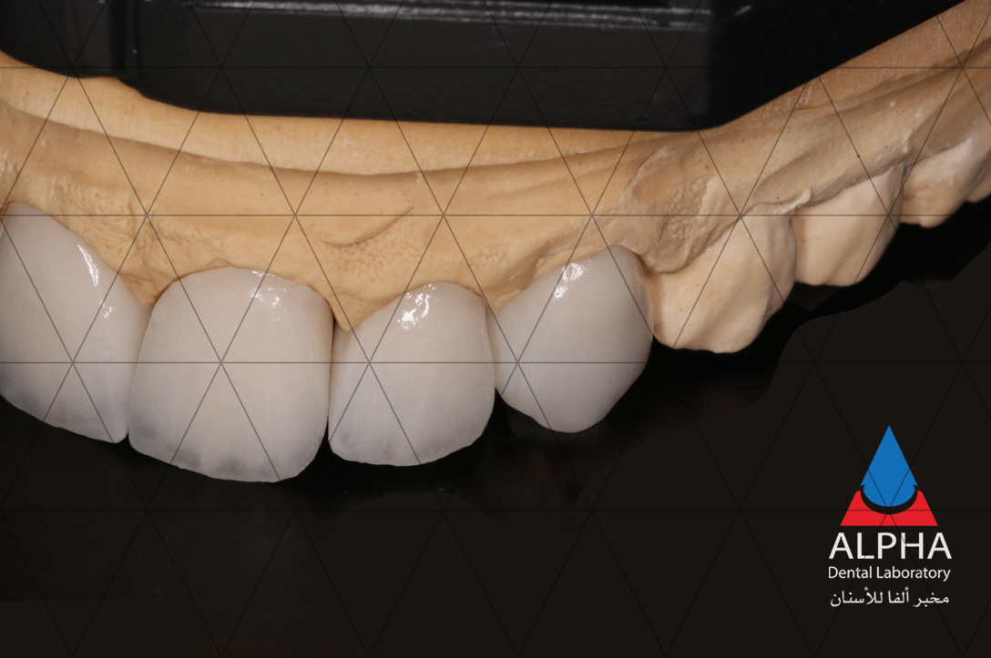 A set of high quality 5 unit veneers made by Alpha Dental Laboratory 🦷✨