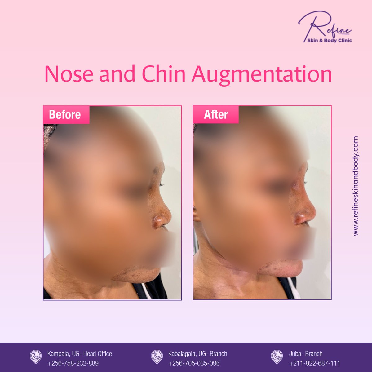 RefineClinicUG's tweet photo. Enhance your features with #nose and #chinaugmentation at #RefineSkinandBodyClinic. See the stunning before and after transformation of our valued client.
Contact Us:
JUBA: +211 922687111
UGANDA: +256 758232889 / +256 705035096
#chin #noseaugmentation #refineskinandbodyclinic https://t.co/x6VZALO7jj