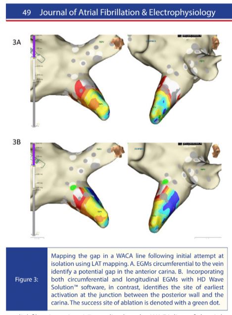 Mapping Gaps in Pulmonary Vein Isolation Lesion Sets with Advisor™ HD Grid Mapping Catheter, Sensor Enabled™, HD Wave Solution™ Software and EnSite™ Omnipolar Technology   buff.ly/3OeDdyL  @abbottcardio