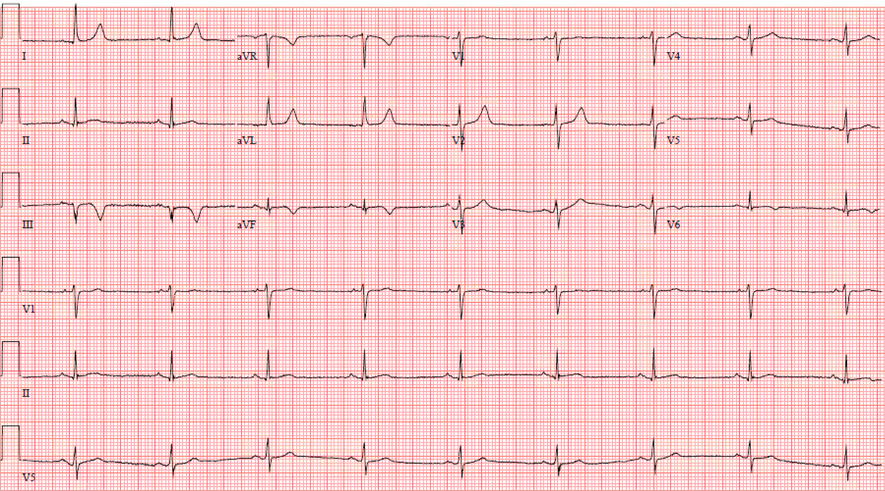Chest pain and T wave inversion, NSTEMI?  <a href="/ECGcases/">Jesse McLaren</a> 

hqmeded-ecg.blogspot.com/2023/08/chest-…