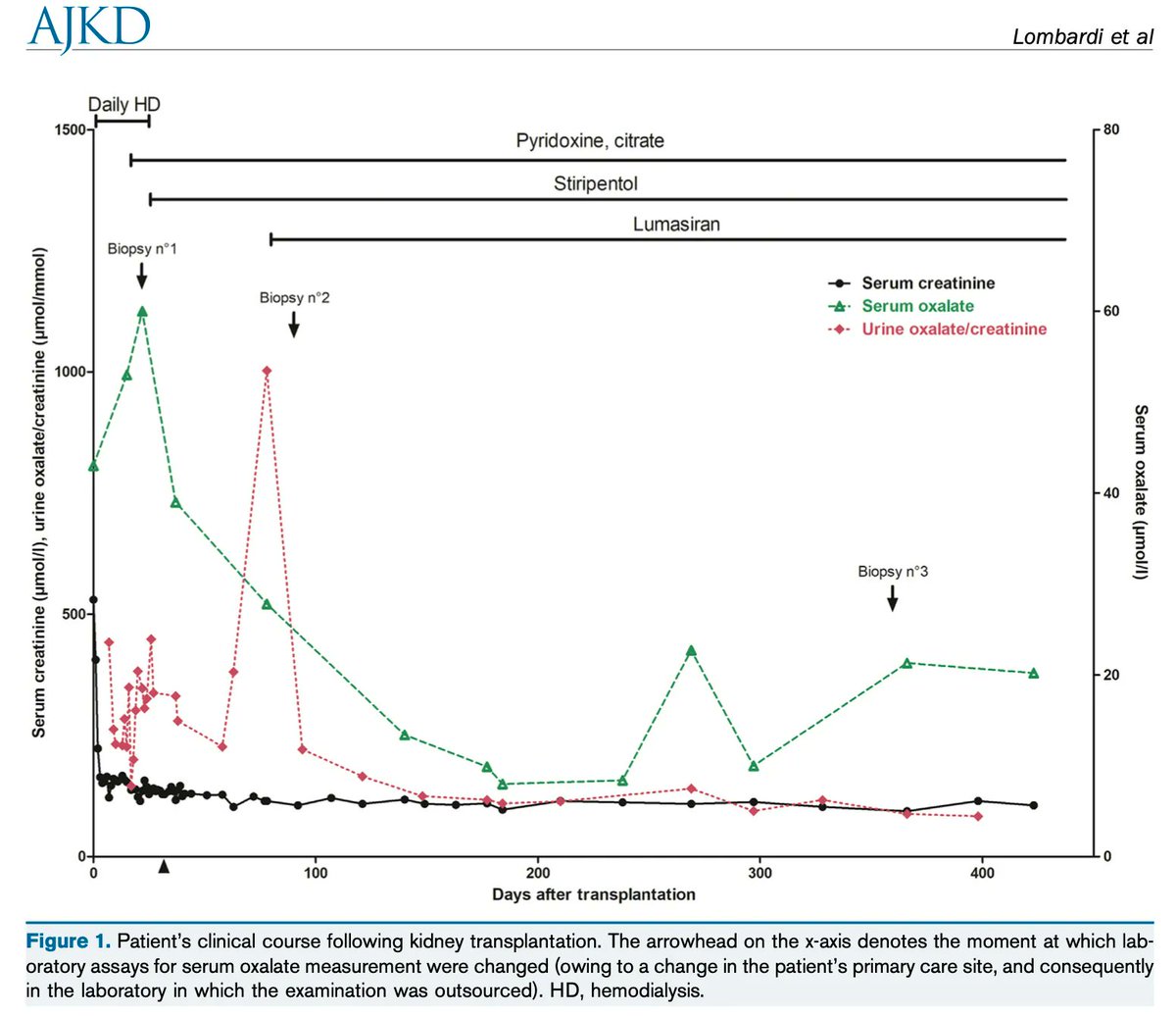 AJKD (@ajkdonline) on Twitter photo Stiripentol and Lumasiran as a Rescue Therapy for Oxalate Nephropathy Recurrence After Kidney Transplantation in an Adult Patient With Primary Hyperoxaluria Type 1
buff.ly/3XINmXK
<a href="/YannisLombardi/">Yannis LOMBARDI</a> <a href="/IsnardPierre1/">Isnard Pierre</a> <a href="/ChavarotN/">Chavarot Nathalie</a> <a href="/chauvet_sophie/">Sophie Chauvet</a> <a href="/EricThervet/">Eric Thervet</a> <a href="/DanyAnglicheau/">Dany Anglicheau</a> Stiripentol and Lumasiran as a Rescue Therapy for Oxalate Nephropathy Recurrence After Kidney Transplantation in an Adult Patient With Primary Hyperoxaluria Type 1
buff.ly/3XINmXK
<a href="/YannisLombardi/">Yannis LOMBARDI</a> <a href="/IsnardPierre1/">Isnard Pierre</a> <a href="/ChavarotN/">Chavarot Nathalie</a> <a href="/chauvet_sophie/">Sophie Chauvet</a> <a href="/EricThervet/">Eric Thervet</a> <a href="/DanyAnglicheau/">Dany Anglicheau</a>