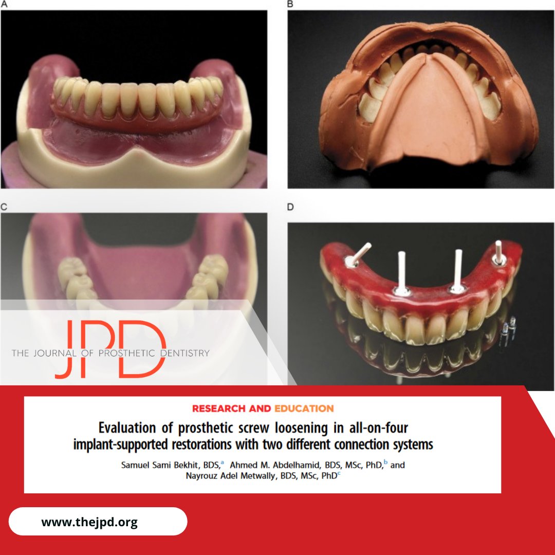 JPDentistry's tweet photo. This #inpress #theJPD article compares prosthetic screw torque when utilizing an #overdenture attachment system with #fixeddentalprosthesis conversion option as compared to conventional #multiunitabutment #screwretained complete arch #implantprosthesis: https://t.co/q3RUYNeQdL https://t.co/ZTJi1iQTFf