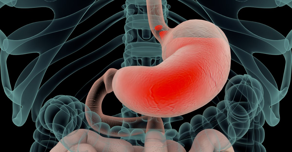 WebMD's tweet photo. Prolonged use of acid reflux medications called proton pump inhibitors could increase the risk of developing dementia, a new study shows. https://t.co/BYvNL3RyRb https://t.co/zGh2Tsf4Kd