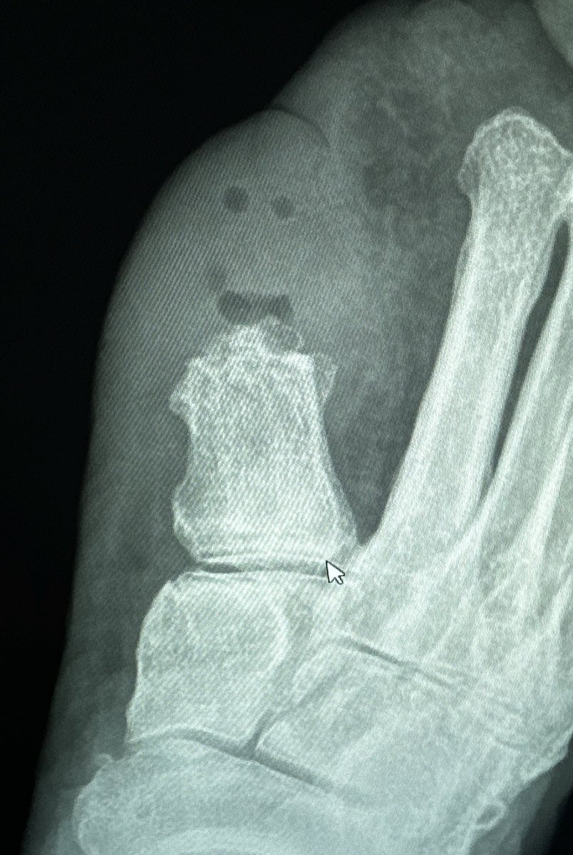 jmacatol's tweet photo. Osteo ghost snacking @morrisonMSK https://t.co/zMYsbUS7L3