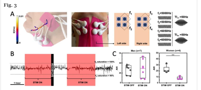 BioelectronicM's tweet photo. Out yesterday, "Obstructive sleep apnea improves with non-invasive hypoglossal nerve stimulation using temporal interference" #SleepApnea #OSA #NerveStimulation #BioelectronicMedicine #SleepDisorders https://t.co/Kbohgs0S95 https://t.co/RV7xsh4F0C