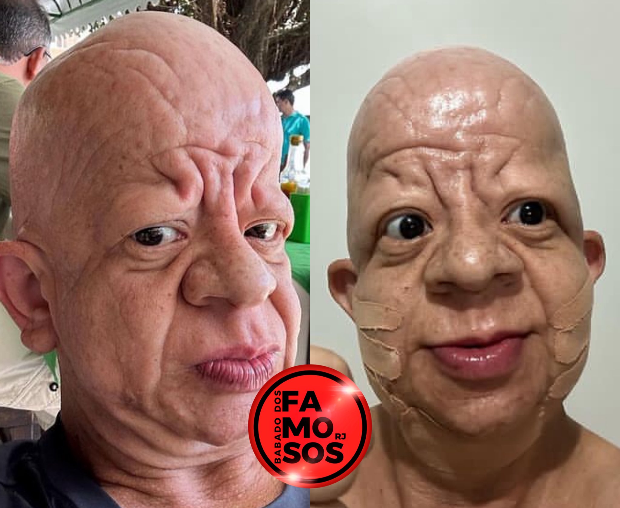 Bruno Diferente faz harmonização facial e compartilha resultado na web, Celebridades