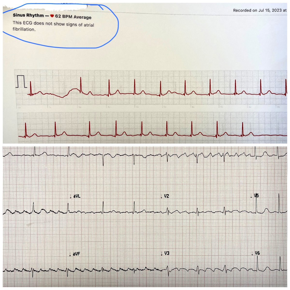 This 84 year old patient cancelled her cardioversion because she was in a normal rhythm according to her watch. Still fatigued, though. At her next appointment we compared the live watch recording to the ECG. #CardioEd #CardioTwitter #MedEd #JobSecurity