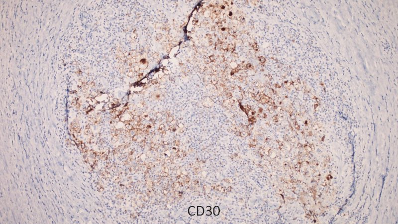 When cyto leads the way to a hemepath diagnosis. FNA lymph node in a young patient. Classical Hodgkin Lymphoma- Nodular Sclerosis subtype. #PathTwitter #hemepath #cytology #lymphoma #pathology #hodgkin