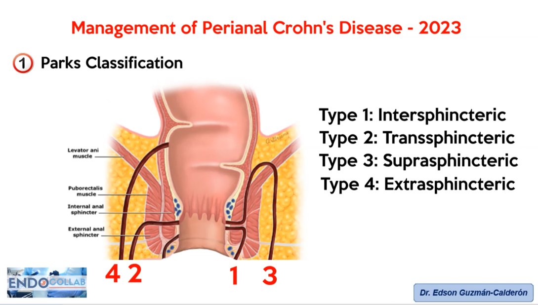 Management of Perianal Crohn's Disease - 2023
Alyssa M. Parian, et al. AJG 2023

📺youtu.be/WkSWDvea04A

<a href="/AmJGastro/">AJG - The American Journal of Gastroenterology</a> <a href="/alyssaparian/">Alyssa Parian</a> <a href="/CrohnColitisCL/">Crohn Colitis Chile</a> <a href="/enfermedadcrohn/">Enfermedad de Crohn</a> <a href="/IBDHopkins/">Johns Hopkins IBD</a> <a href="/Aced1970/">Asociación Colombiana de Endoscopia Digestiva.ACED</a> <a href="/EndoscopiaH/">EndoscopiaHGUA</a> <a href="/SEEDendoscopia/">SEED</a> <a href="/sepdigestiva/">Sociedad Española de Patología Digestiva (SEPD)</a> <a href="/RevGastroPeru/">RevGastroPeru</a> <a href="/KMonkemuller/">Klaus Mönkemüller, MD, PhD</a> <a href="/OPGEgastro/">Organización Panamericana de Gastroenterología</a>