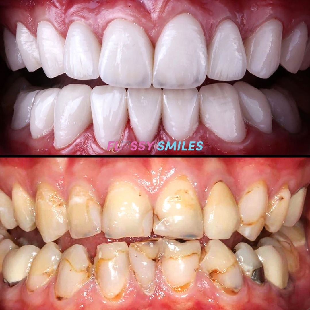 Dental Veneers

Dr. Gio is 📍 in Miami, FL 
✈️Seeing patients from all over the USA 
🗓Get your new smile in 2 Visits 
📱 We offer in-office or virtual consultations 
💳 Financing is available 
☎️ Our office Monday-Thursday from 9-5  
💻Visit our website: DrFlossysmiles.com