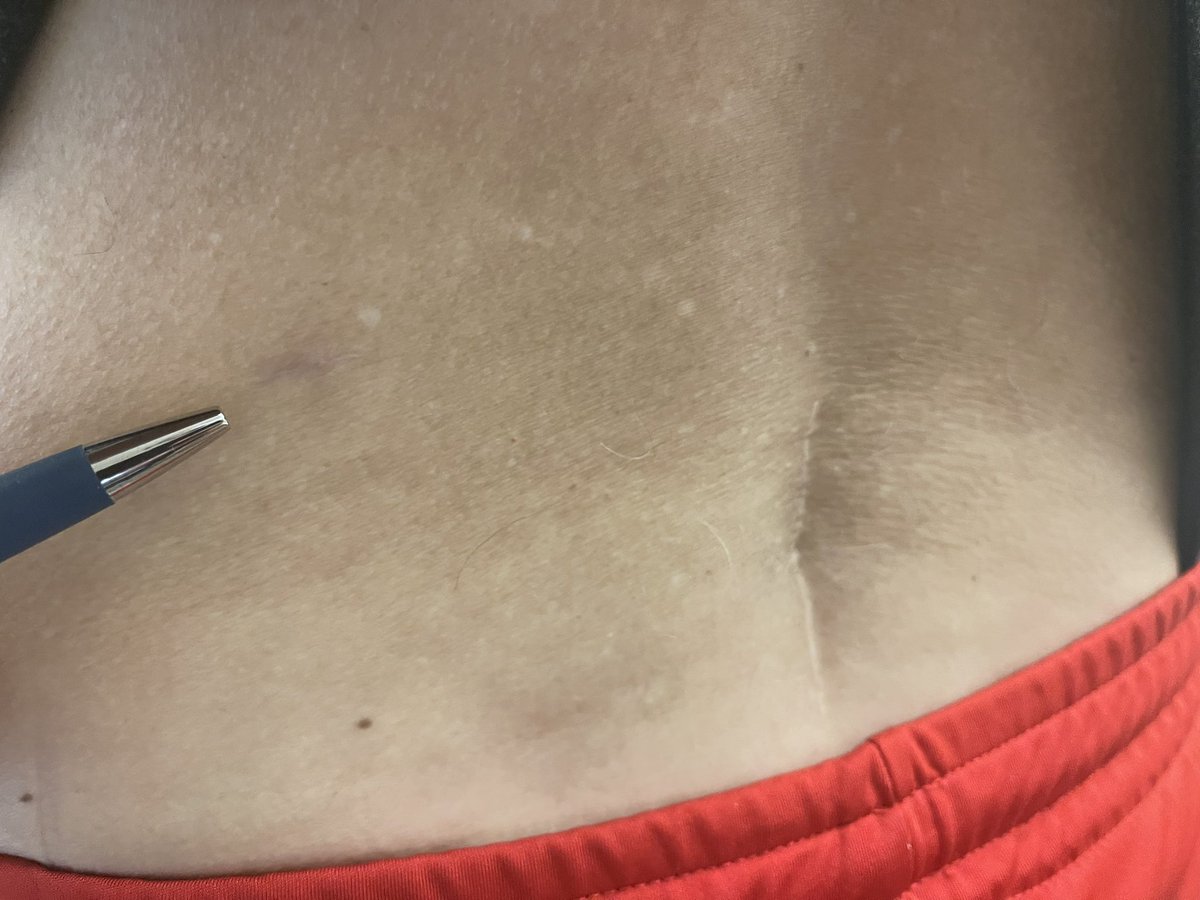 gardocki_ray's tweet photo. Midline incision was an open discectomy. Incision indicated by the pen is 3 months post transforaminal endoscopic approach for a recurrent disc at the previously operated level. This patient explained how much easier the endoscopic surgery is to recover from than the open.
#ESRG https://t.co/a1BDd50Y66