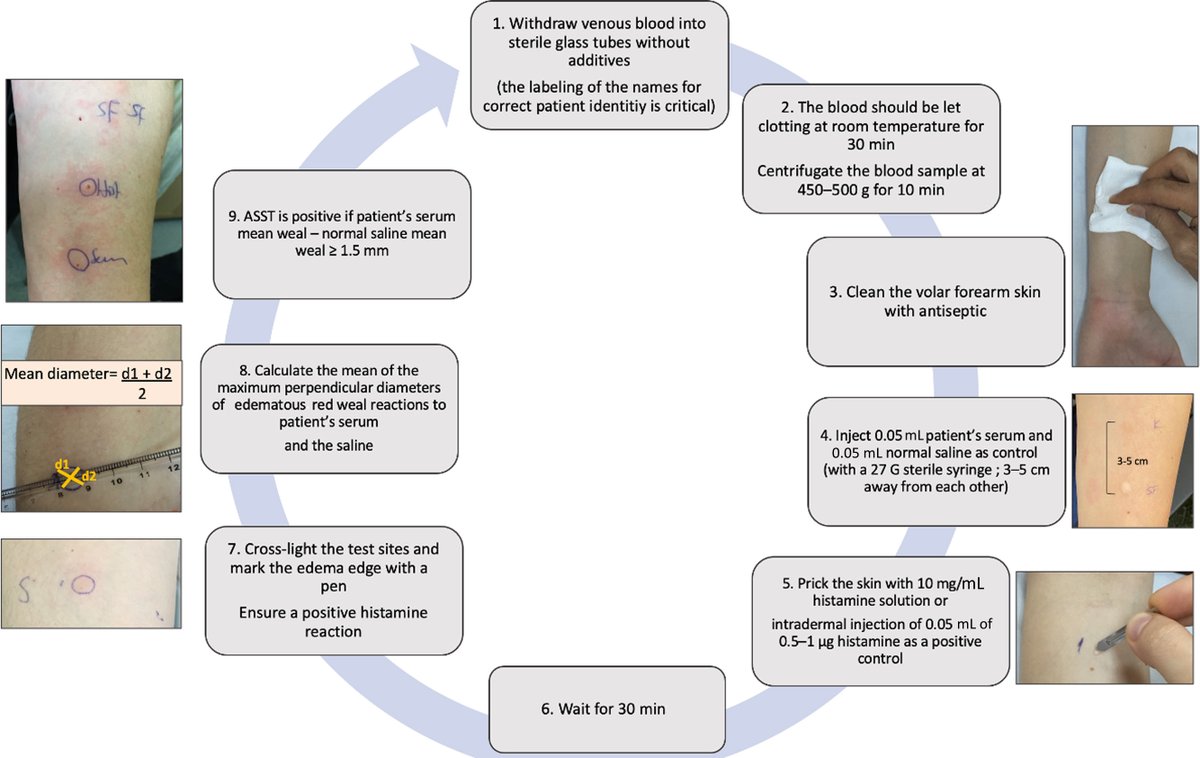 JACIInPractice's tweet photo. In Current Issue! #Chronic #Spontaneous #Urticaria: The Role and Relevance of #Autoreactivity, #Autoimmunity, and #Autoallergy https://t.co/QqI4tnl4VF https://t.co/PvJ7pGnjfj
