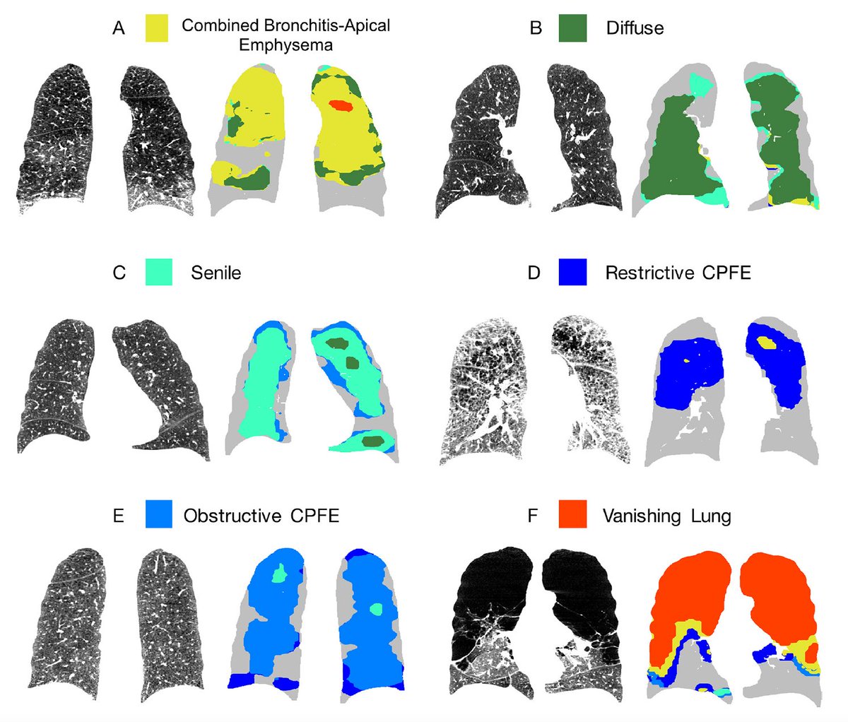 Unsupervised machine learning identified six CT emphysema subtypes with distinct symptoms, physiology and prognosis. <a href="/ThoraxBMJ/">ThoraxBMJ</a> thorax.bmj.com/content/early/…