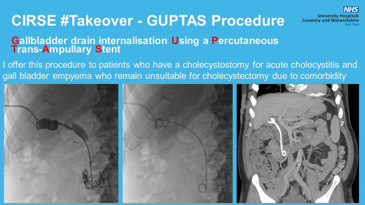 cirsesociety's tweet photo. #CIRSEtakeover @DrNeilGuptaIR
Day 5: In 2018, I started performing cholecysto-duodenal stenting for patients unfit for surgery following cholecystostomy. Great success, no complications &amp; awesome patient satisfaction. Anyone else doing this for benign gallstone disease? https://t.co/e5uGiQNj0k
