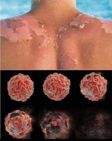 EnsedeCiencia's tweet image. Cuando te quemas por el sol, no son las células de tu piel las que se dañan y mueren, en realidad es el ADN que se daña y luego las células deciden autodestruirse para evitar convertirse en cáncer. 

Este proceso se llama apoptosis.