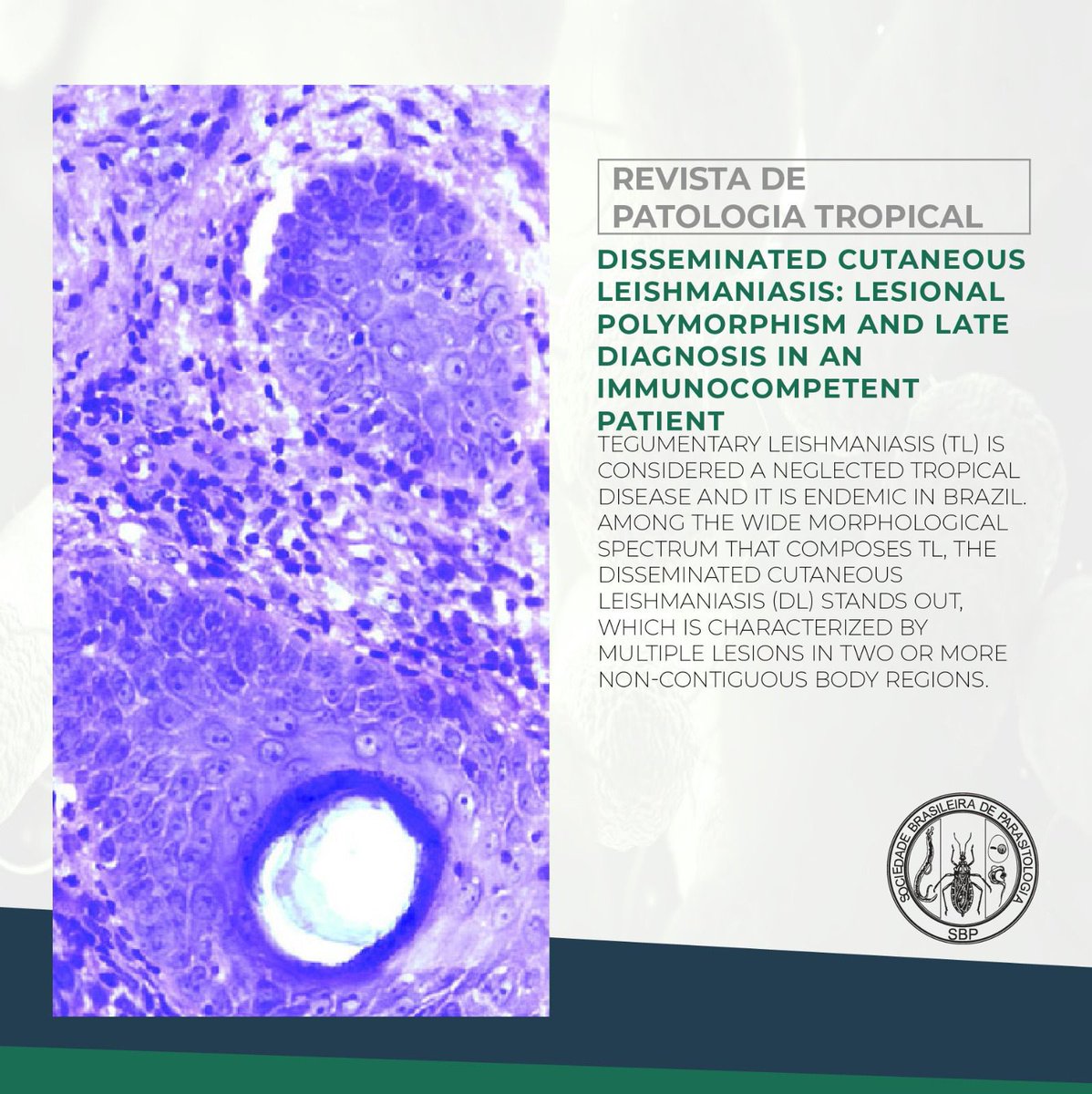 Confira o artigo “Disseminated cutaneous leishmaniasis: lesional polymorphism and late diagnosis in an immunocompetent patient” na Revista de Patologia Tropical.

Acesse: revistas.ufg.br/iptsp/article/…

#publicacao 
#publicações 
#parasitologia 
#parasito