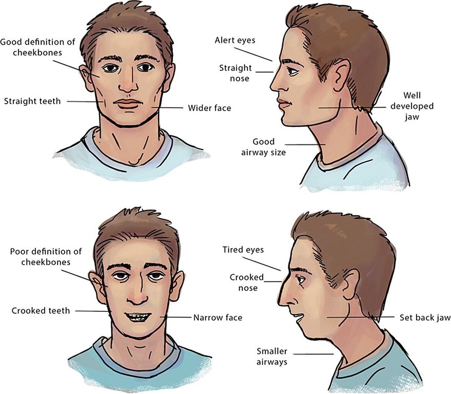The difference between a life-long nasal breather and a life-long mouth breather can be seen in the...