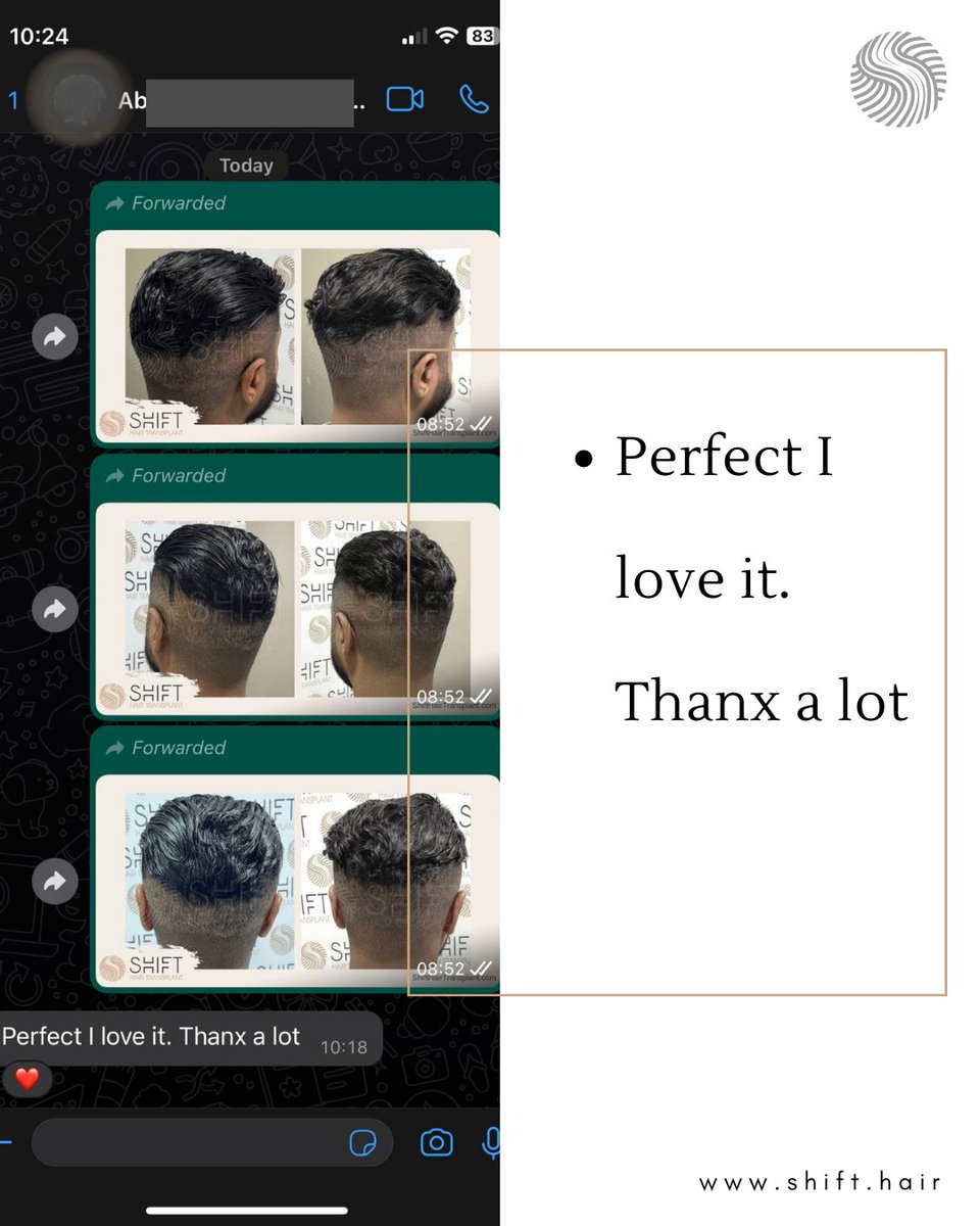 shifthairtr's tweet image. A testimonial for a micropigmentation in Istanbul with SHIFT in Turkey

#scalpmicropigmentation #micropigmentation #smp #hairtattoo #hairshading #micropigmentationturkey #micropigmentationistanbul #micropigmentationinturkey #micropigmentationinistanbul #micropigmentationartist