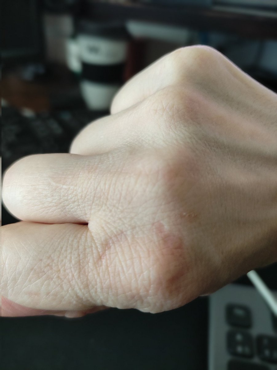 ConcienCEA's tweet photo. Esos dientes que se ven ahí marcados, ya difuminados porque ha pasado un buen rato, son los míos y la mano también.
Cuando los autistas nos saturamos demasiado podemos terminar con  un #Meltdown y llegar a autolesionarnos.
Esto también es #autismo.
#SoyAutista #Autimo #TEA #CEA https://t.co/tLsu9nBlN8