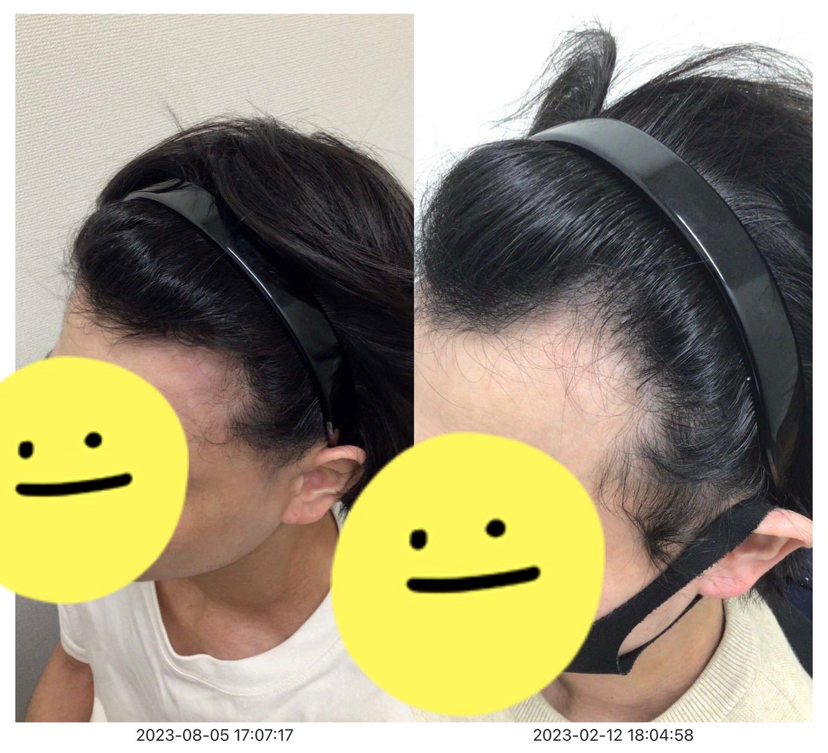 30s_aga's tweet photo. 【180日目】
AGA治療をはじめて180日が経過しました！！

・M字部分はかなり改善
・塗り薬は肌に合わないため飲み薬のみ服用
・そのほかは特になにもせず

半年でかなり効果は実感しはじめました。
クリニックのスタッフも優しく聞いてくれるのでかなり安心。

←現在　180日前→ https://t.co/wIqG2g22MZ