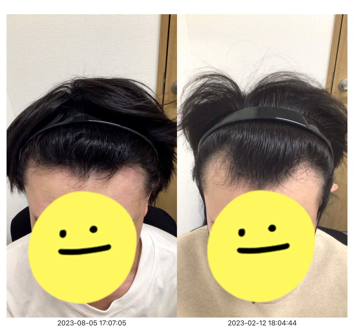 30s_aga's tweet photo. 【180日目】
AGA治療をはじめて180日が経過しました！！

・M字部分はかなり改善
・塗り薬は肌に合わないため飲み薬のみ服用
・そのほかは特になにもせず

半年でかなり効果は実感しはじめました。
クリニックのスタッフも優しく聞いてくれるのでかなり安心。

←現在　180日前→ https://t.co/wIqG2g22MZ