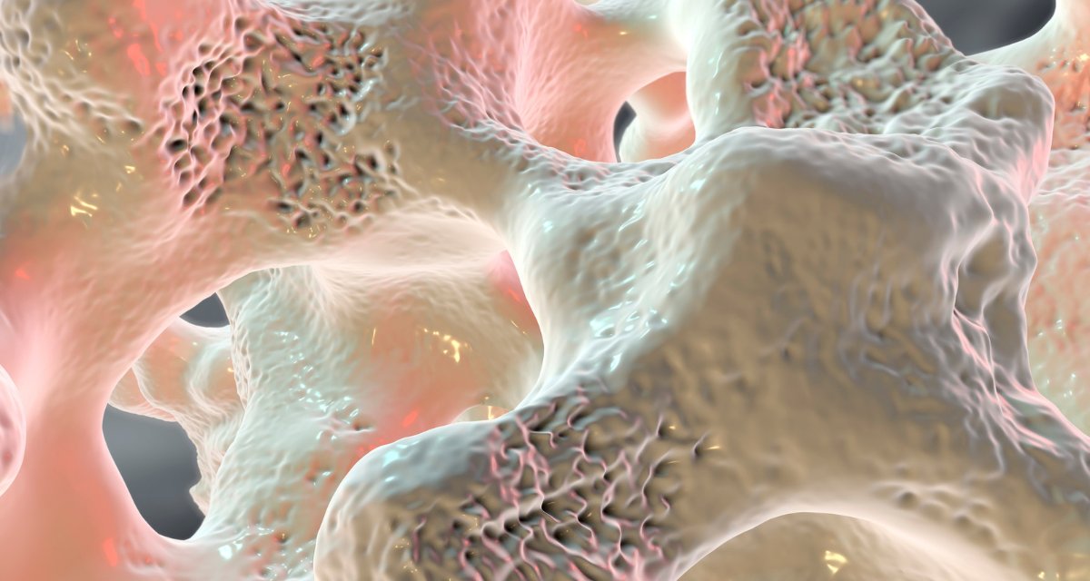 New 📰 to read!
Oral Therapeutics Post #Menopausal #Osteoporosis by Schroeder R. J. et al.
The goal of oral therapy in post-menopausal osteoporosis is a reduction in fracture risk
Read more ➡️bit.ly/3KAOxEn
<a href="/giuvarr/">giuvarr</a>