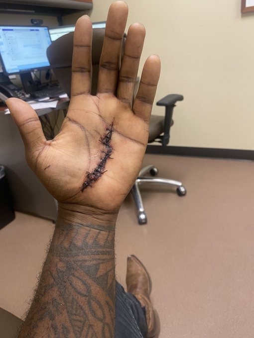 Now that it's healing I can show you guys. This is why I haven't been making nutt vids. https://t.co