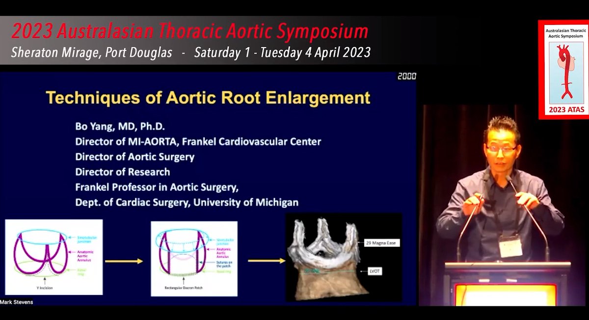 .<a href="/BoYangMD/">Bo Yang</a> recently presented on his techniques for aortic root enlargement at the 2023 Australian Thoracic Aortic Symposium, discussing his techniques for aortic root enlargement. Recording brought to you by CTSNet.

 🔗ow.ly/OtAz50PxGzq