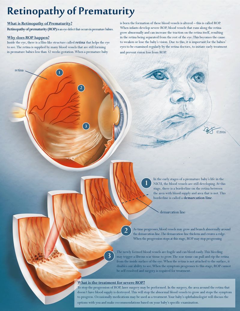 Celebrating Children’s Eye Health and Safety Month with our illustration about retinopathy of prematurity(ROP). This project is created in collaboration with NICU department at the UNIVERSITY OF ILLINOIS HOSPITAL.

#medicalillustration #medicalaffairs #medaffairs #nicu