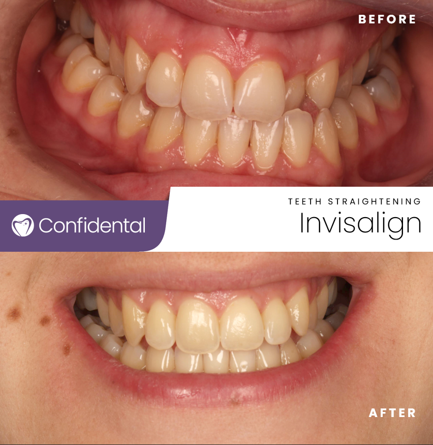 ConfidentalUK's tweet photo. Bringing smiles to life, one Invisalign success story at a time! 🌟 Seeing our patient's happiness radiate through their beautifully aligned teeth is what drives us every day. #SmileJourney #InvisalignResults #DentalAchievement #HealthyTeeth #BeautifulSmile https://t.co/xzgq4PLUzh