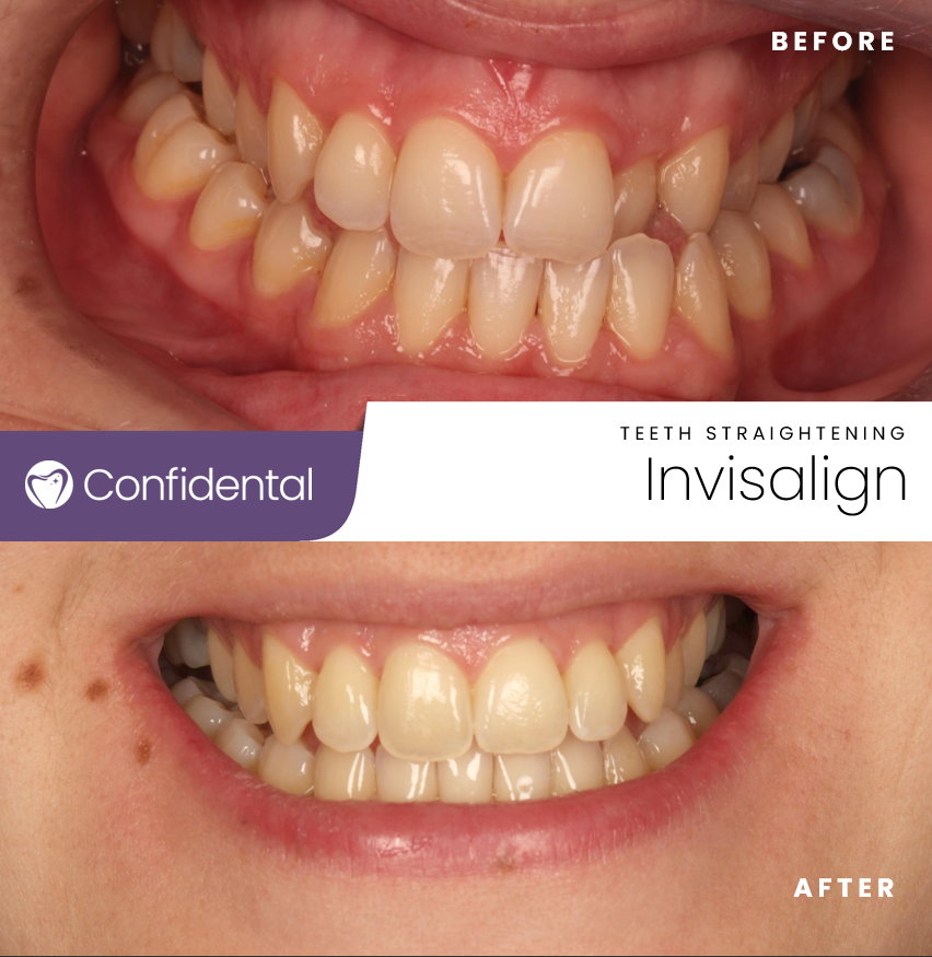 Bringing smiles to life, one Invisalign success story at a time! 🌟 Seeing our patient's happiness radiate through their beautifully aligned teeth is what drives us every day. #SmileJourney #InvisalignResults #DentalAchievement #HealthyTeeth #BeautifulSmile