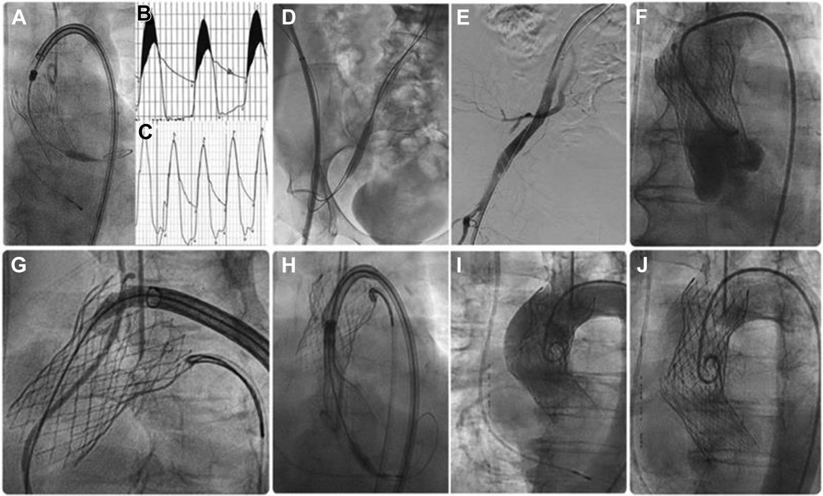 MyJSCAI's tweet photo. 📑Transcatheter Aortic Valve Embolization following Chest Compression during CPR #ValveEmbolization #TAVR
➡️ https://t.co/pbk9Anym8V
@HusamNoor1 https://t.co/7Cafi1lV9S