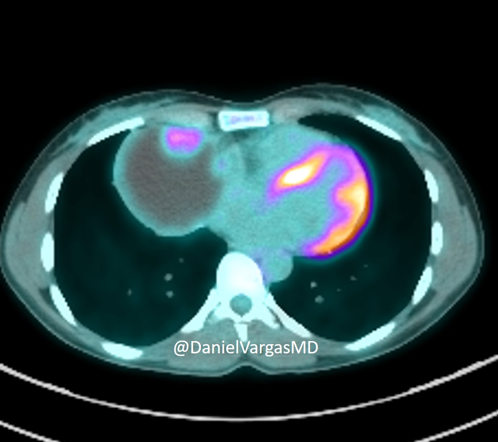 Here's a neat #chestrads case for a Friday morning. 

What are your thoughts? #radres #radiology #FOAMed 

<a href="/JoannaEscalonMD/">Joanna Escalon, MD</a> <a href="/BrixeyAnu/">Anu Brixey, MD</a> <a href="/LeaAzour/">Lea Azour</a> <a href="/draceciferrario/">Dra. Cecilia Ferrario</a> <a href="/TLHM_MD/">Tan-Lucien Mohammed, MD, FACR</a> <a href="/marcosmestas/">Marcos Mestas Nuñez</a> <a href="/blanca_domenech/">Blanca Domenech-Ximenos</a> <a href="/sofia_gambetta/">Sofia Gambetta</a> <a href="/jonherochung/">Jonathan Chung, MD</a> <a href="/DexterMendozaMD/">Dexter Mendoza, MD</a> <a href="/JeannaHarveyMD/">Jeanna Harvey Barnes MD</a>